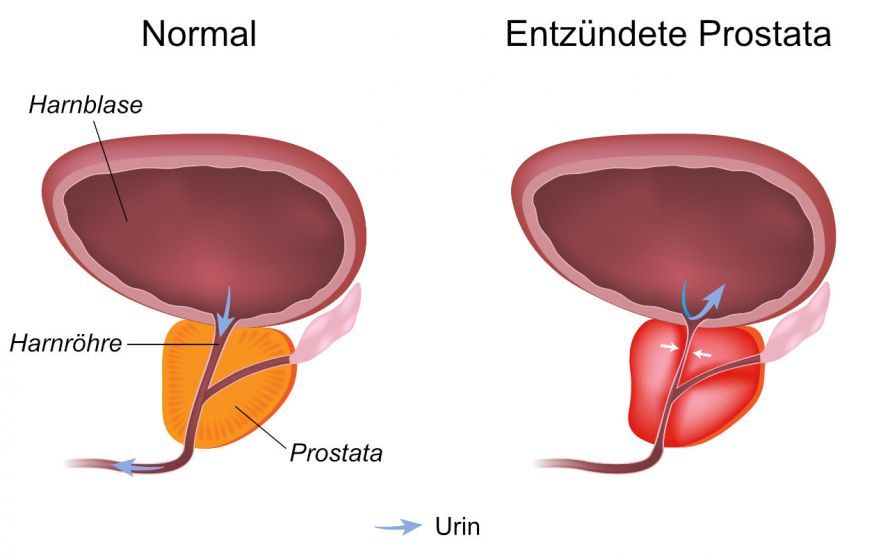 Prostatitis