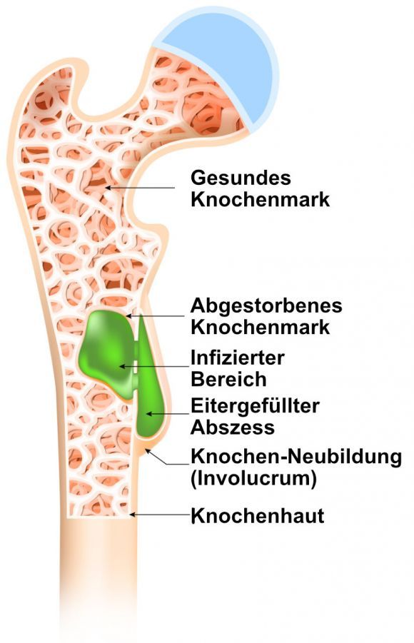 Osteomyelitis - Knochenmarkentzündung