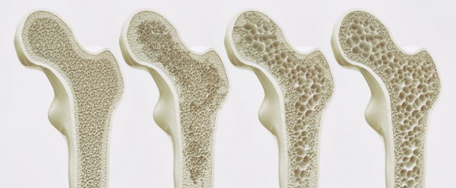 Osteoporose Osteoporose