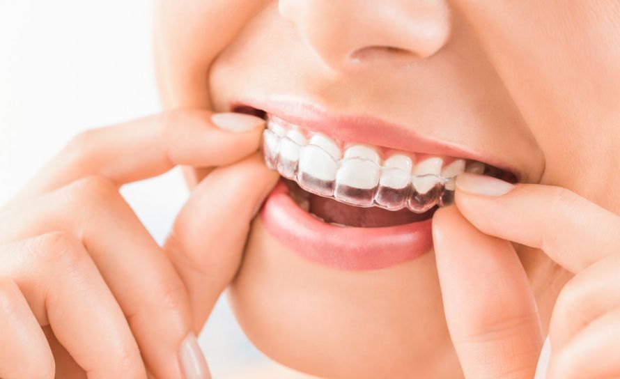 Aligner-Schiene 