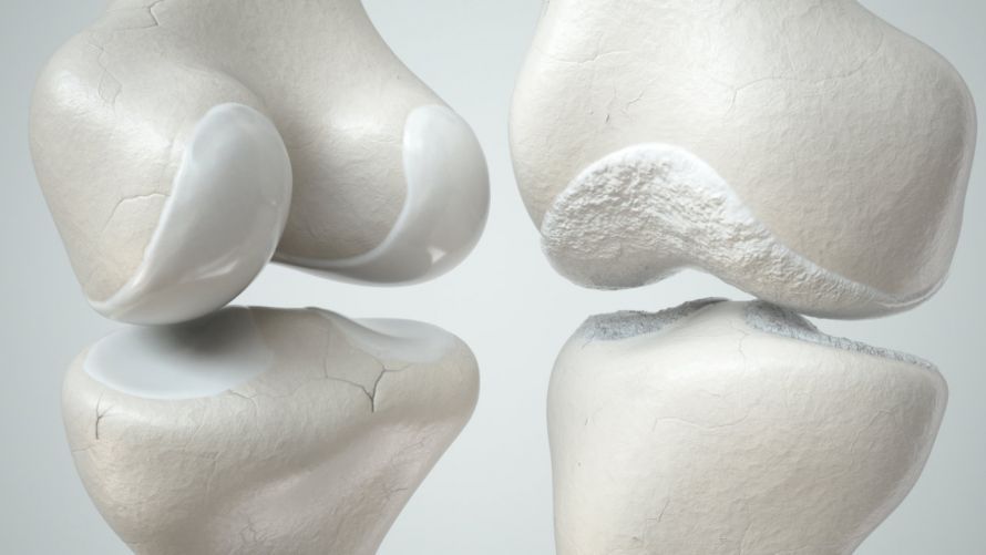 Gesunder Knorpel und geschädigter Knorpel Υγιής χόνδρος και κατεστραμμένος χόνδρος