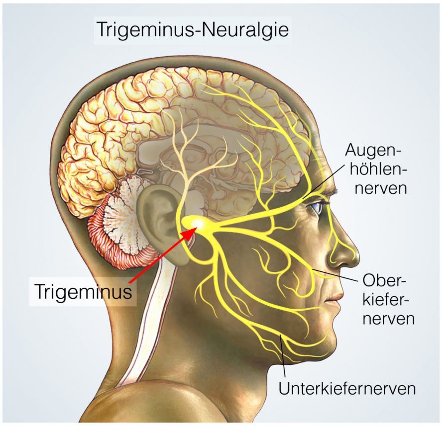 Trigeminusneuralgie Trigeminal Neuralgia