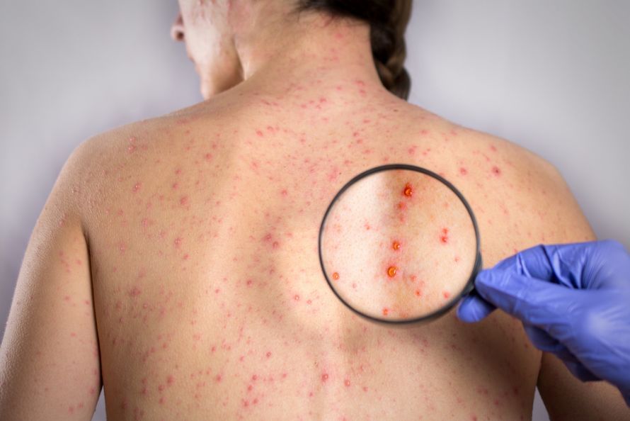 Syphilis