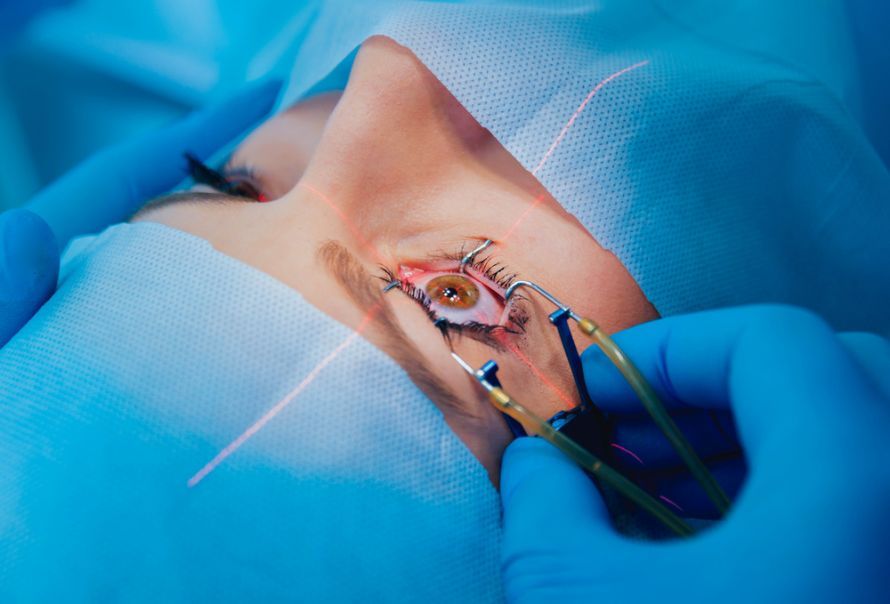 Grauer-Star-Laseroperation (Katarakt-OP) mit dem Femtosekundenlaser