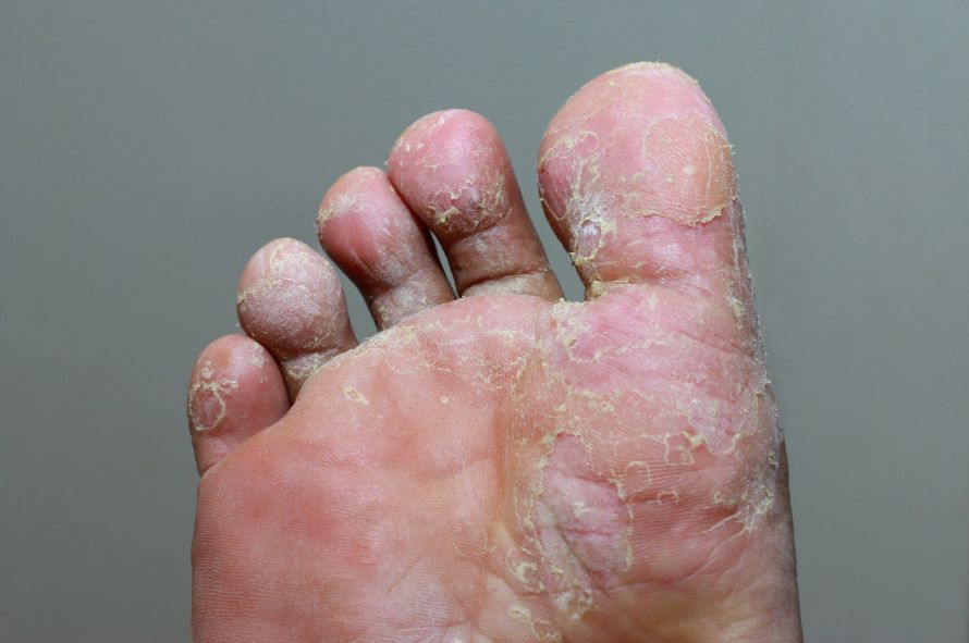 Fußpilz Athlete's foot