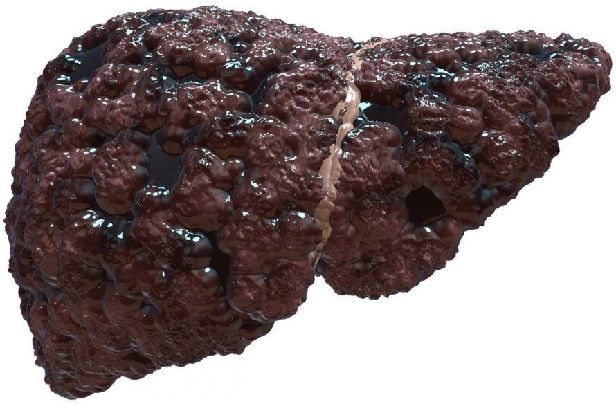Darstellung von Leberzirrhose Darstellung von Leberzirrhose