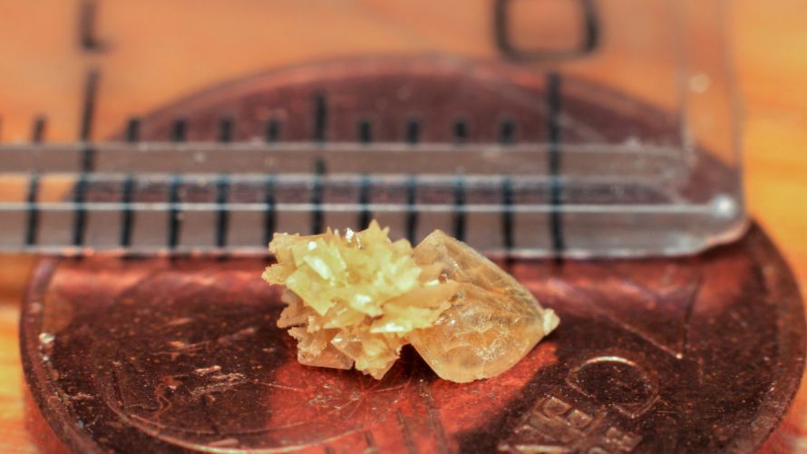 Nierenstein Kidney stone