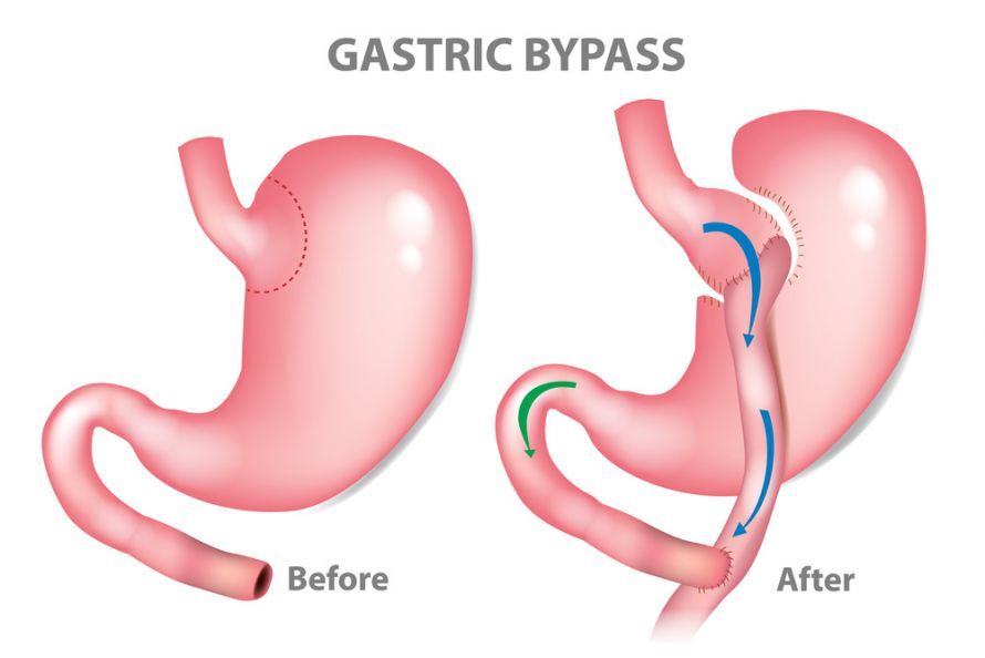 Magenbypass