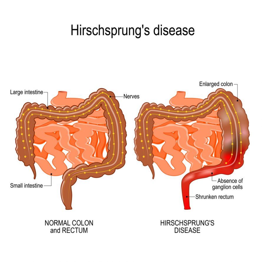 Νόσος του Hirschsprung