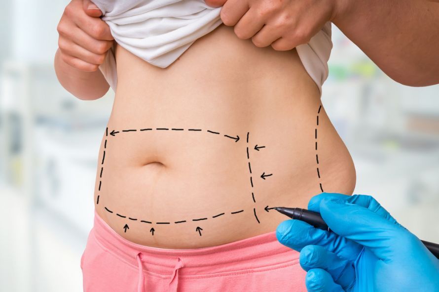 Preparing for Liposuction