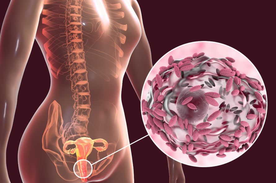Bacterial vaginosis