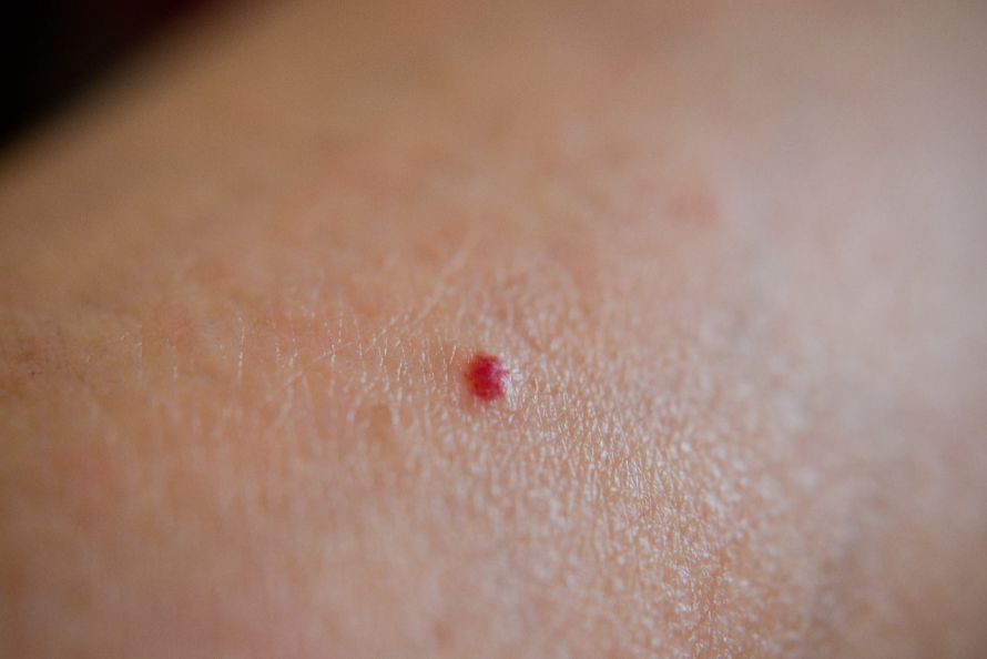Angioma