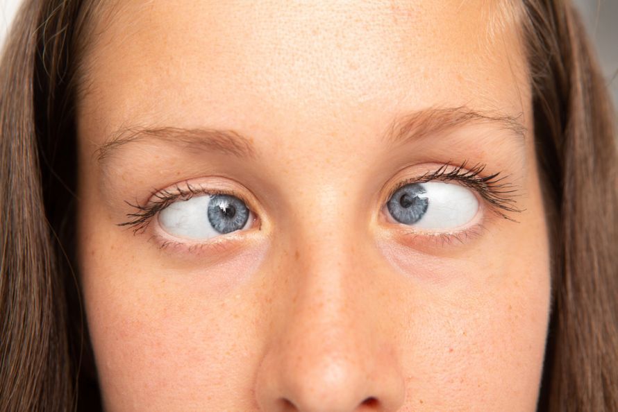 Esotropia