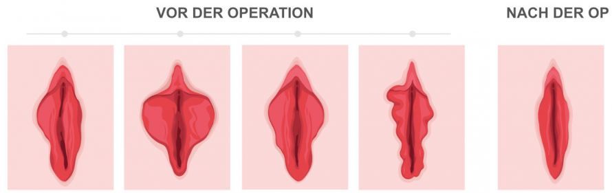 Verkleinerung der inneren Schamlippen Labia Minora Reduction