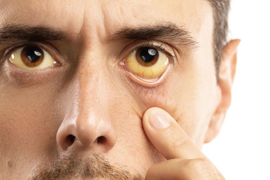 Gelbe Augen bei Gelbsucht Gelbe Augen bei Gelbsucht