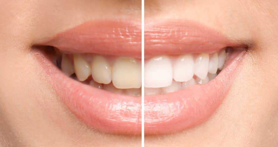 Zahnbleaching Vorher-Nachher-Effekt Zahnbleaching Vorher-Nachher-Effekt
