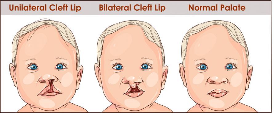 Unilateral and bilateral cleft lip and palate