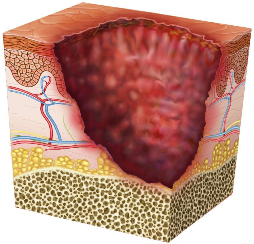 Image of ulcerated skin