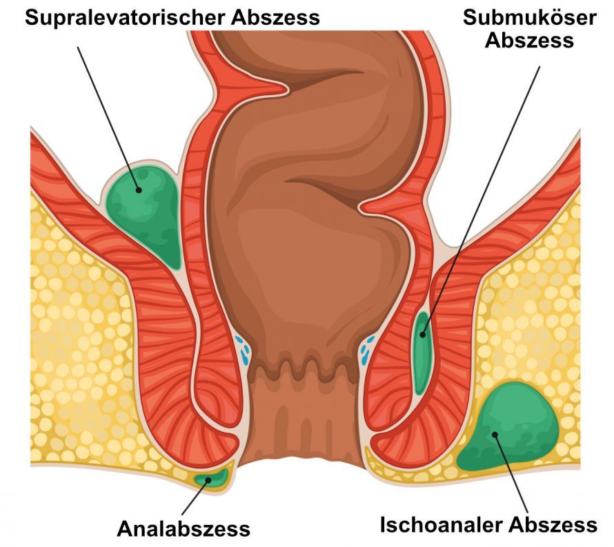 Formen von Analabszessen Types of Anal Abscesses