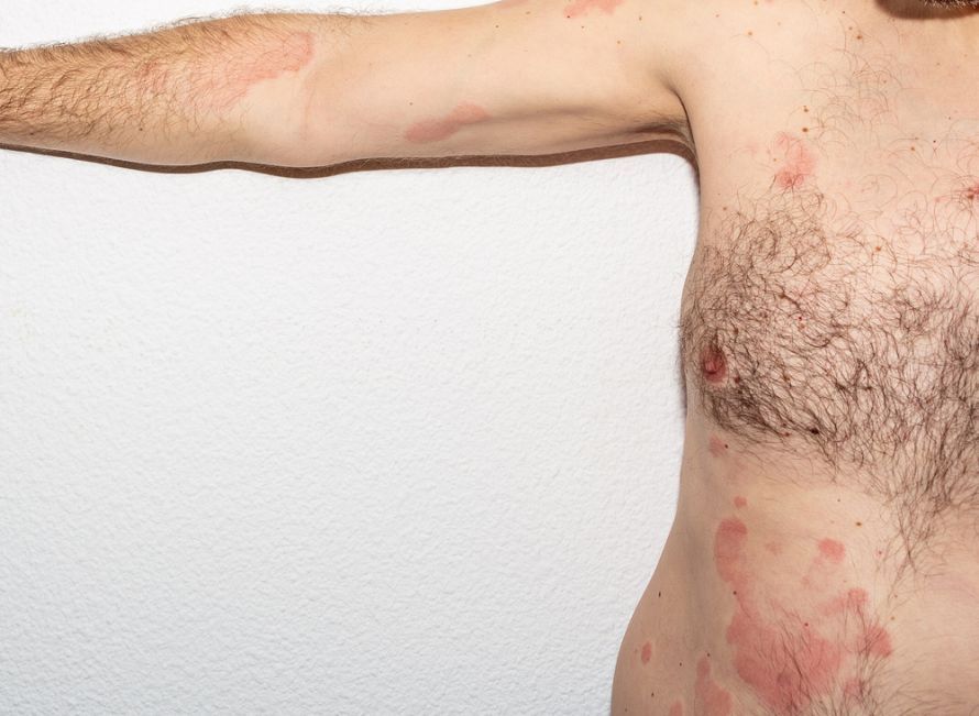 Skin Redness Associated with Histamine Intolerance