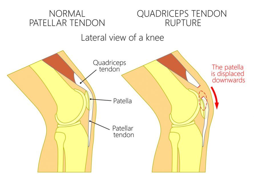 Quadriceps tendon rupture