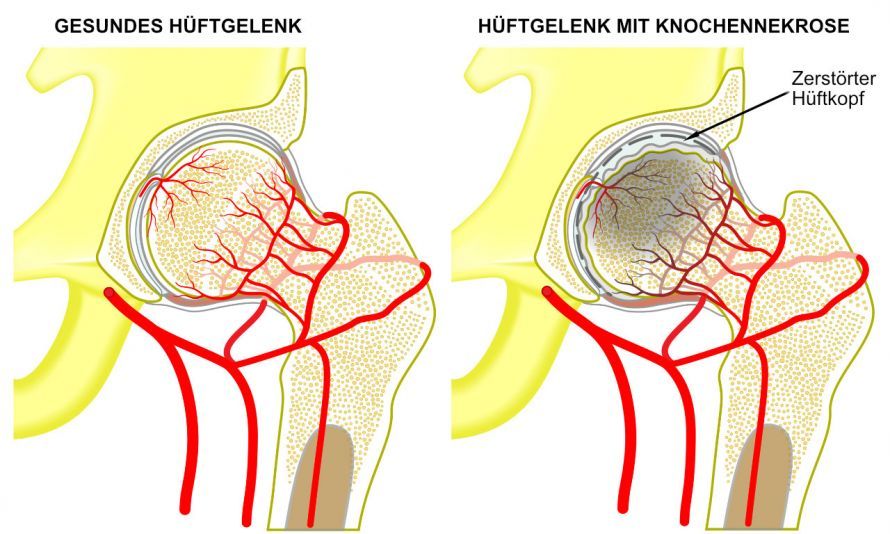 Knochennekrose Knochennekrose