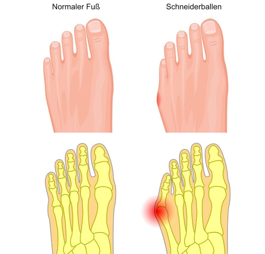 Schneiderballen Schneiderballen