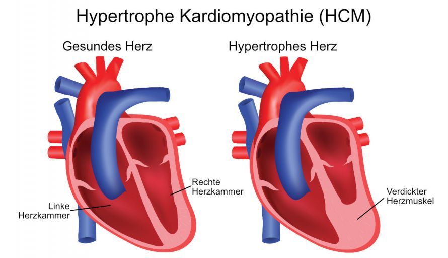 Hypertrophe Kardiomyopathie Υπερτροφική καρδιομυοπάθεια
