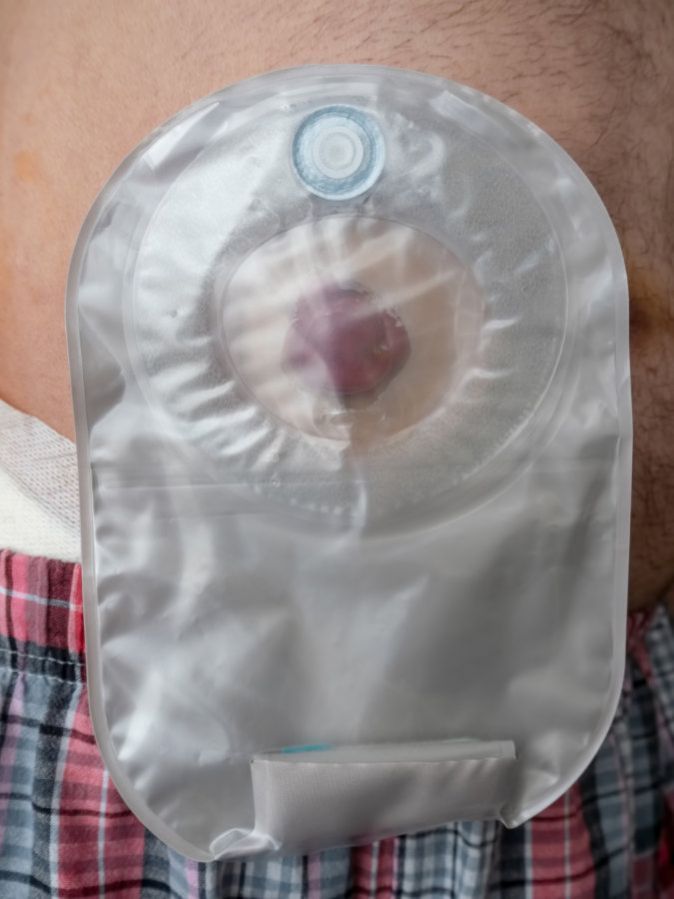 Künstlicher Darmausgang Künstlicher Darmausgang