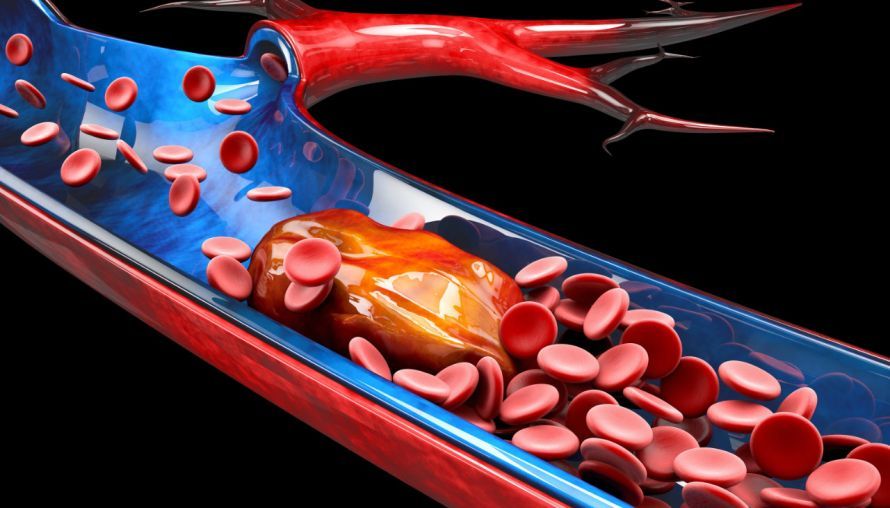 Thrombose: Ein Blutgerinnsel verstopft eine Vene Thrombose: Ein Blutgerinnsel verstopft eine Vene