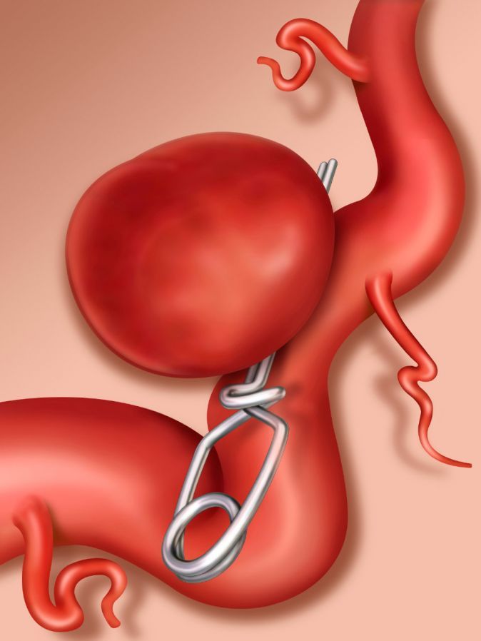 Clipping bei einem Hirnaneurysma Clipping of a Brain Aneurysm