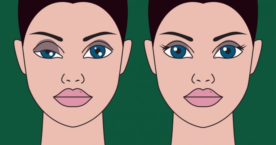 Ptosis Πτώση των βλεφάρων