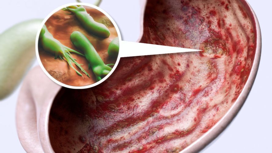 Stomach ulcer