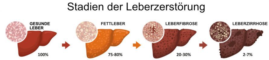 Fettleber - Leberfibrose - Leberzirrhose Λιπώδης ηπατίτιδα - Ηπατική ίνωση - Ηπατική κίρρωση