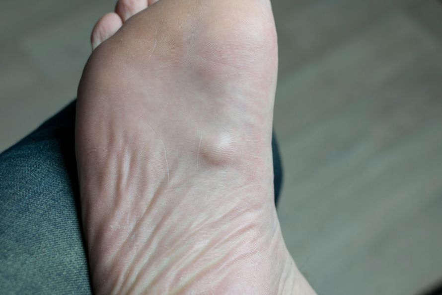 Fibromatosis fascialis / Morbus Ledderhose Fascial fibromatosis / Ledderhose disease