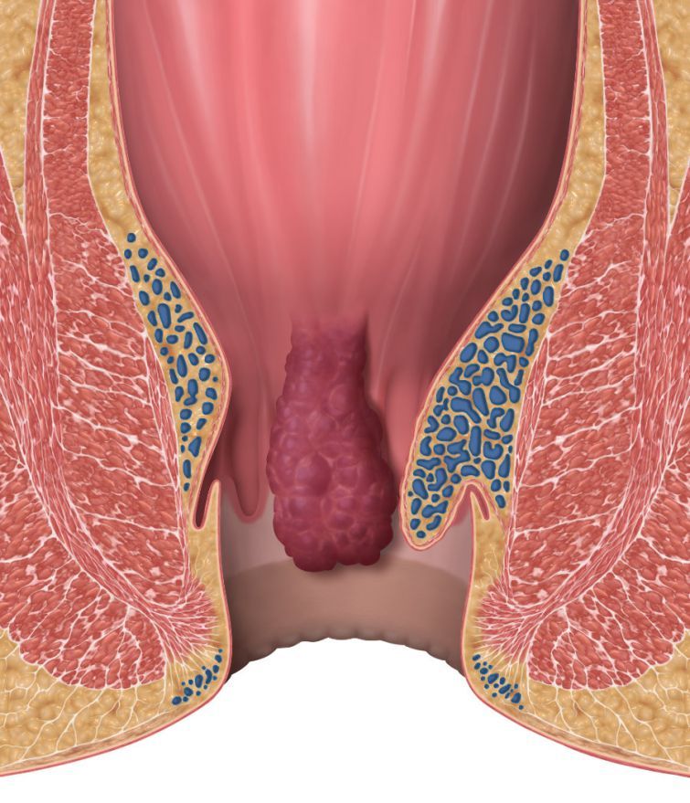 Hämorrhoiden Hämorrhoiden