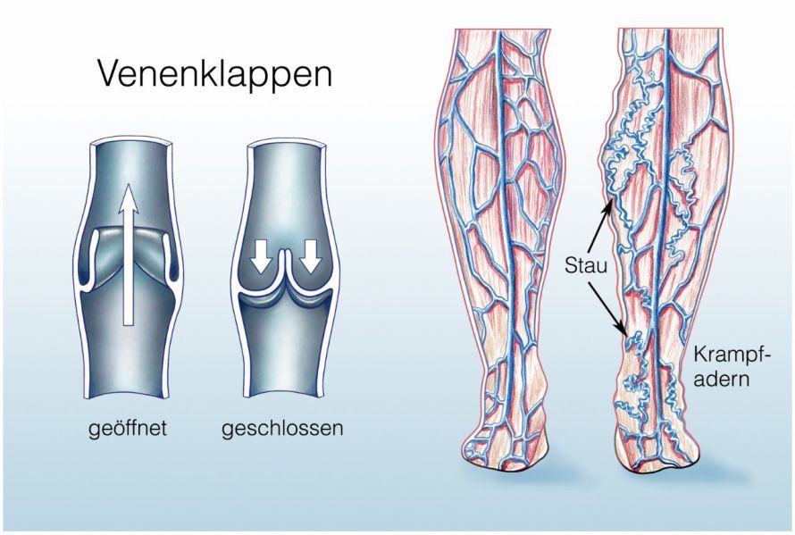 Entstehung von Krampfadern und Besenreisern