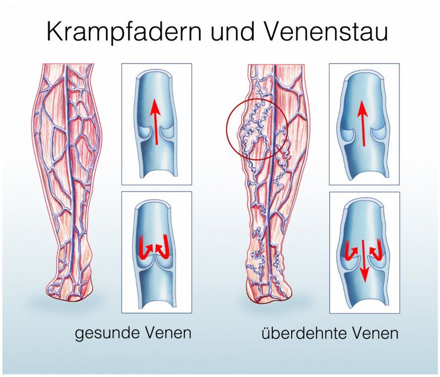 Funktion der Beinvenenklappen und Krampfadern Funktion der Beinvenenklappen und Krampfadern
