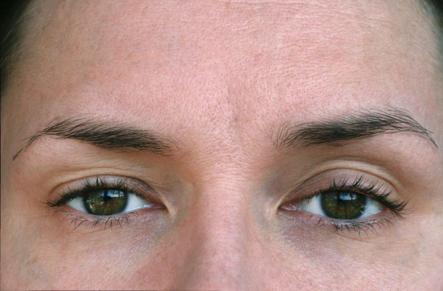 Inkomplette Ptosis des rechten Auges