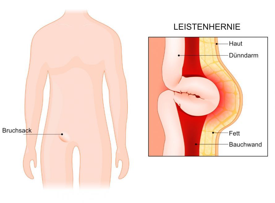 Leistenhernie Leistenhernie