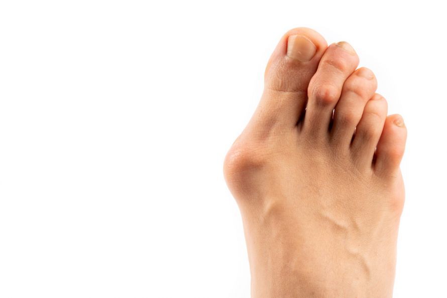 Hallux valgus