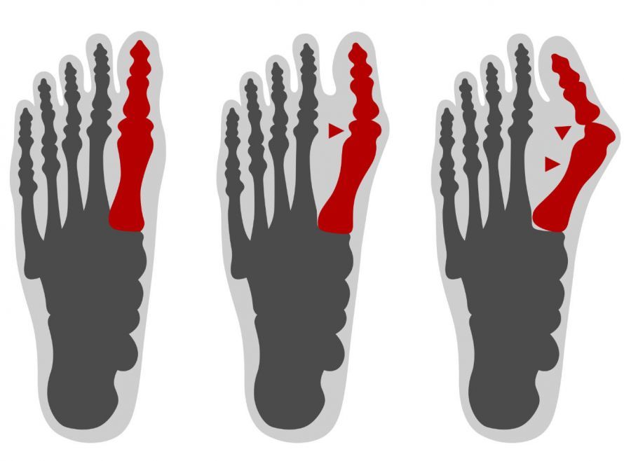 Hallux valgus Hallux valgus