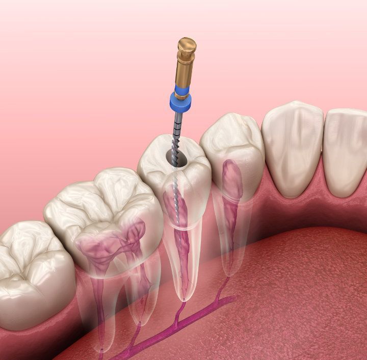 Wurzelkanalbehandlung bzw Endodontie Wurzelkanalbehandlung bzw Endodontie