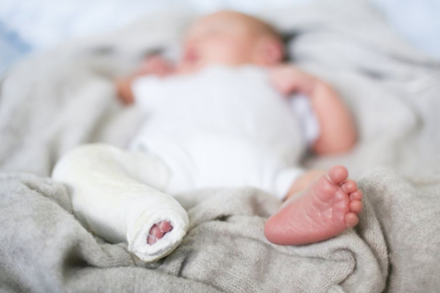 Baby mit Gips am Bein Μωρό με γύψο στο πόδι