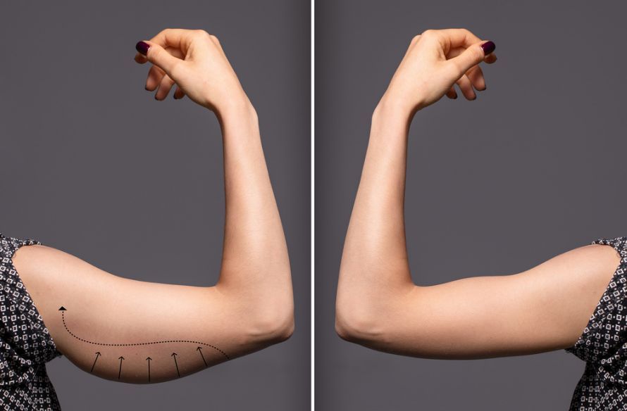 Upper Arm Lift