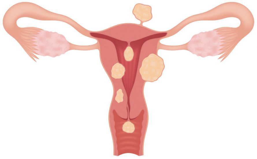 Myome in der Gebärmutter Uterine fibroids