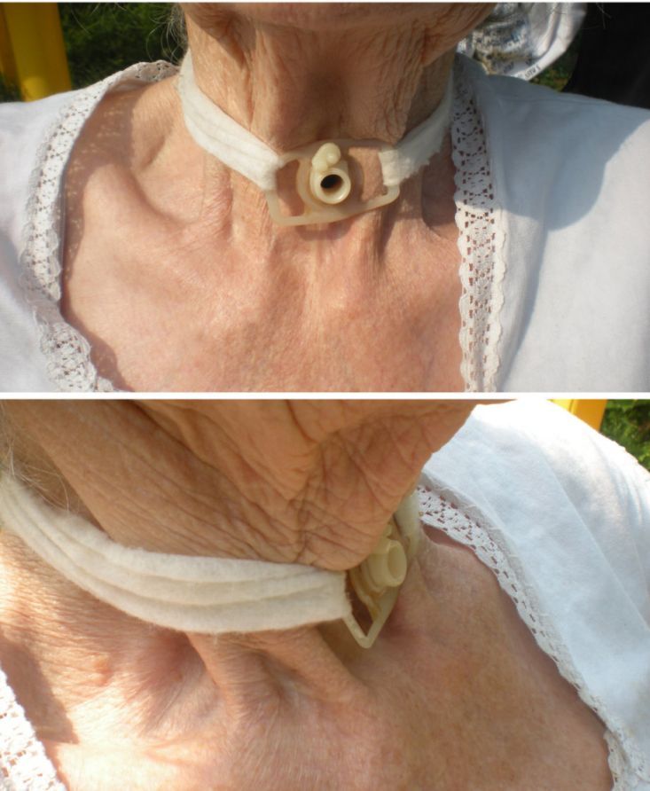 Tracheostomy (artificial breathing opening)