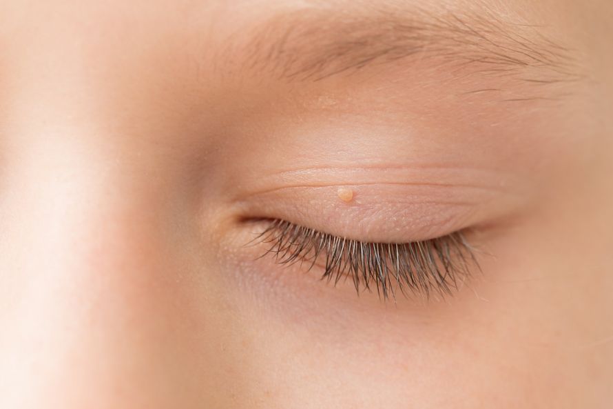 Juvenile Warze bzw. Flachwarze bei einem Kind Juvenile wart or flat wart in a child