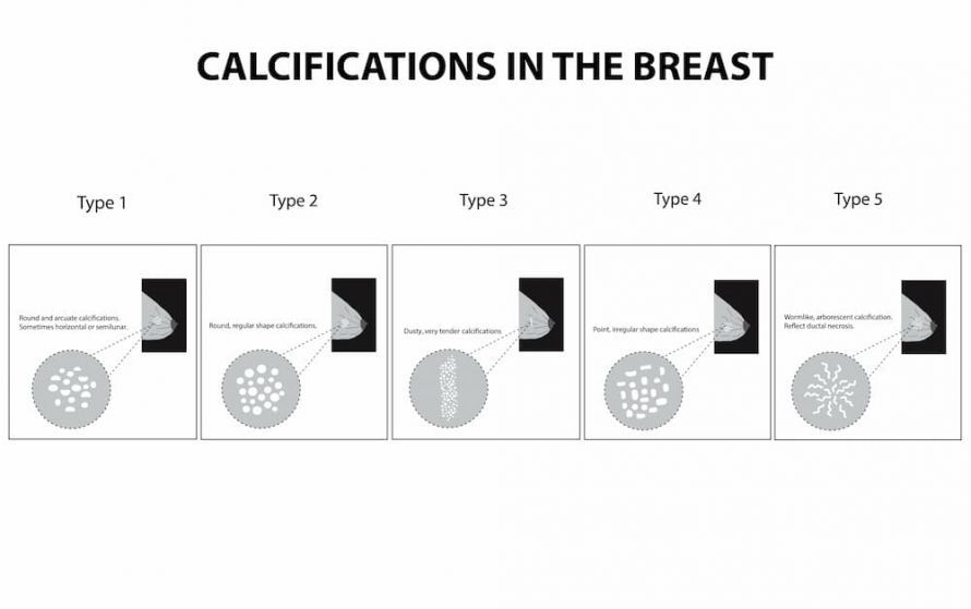 Calcium deposits in the breast