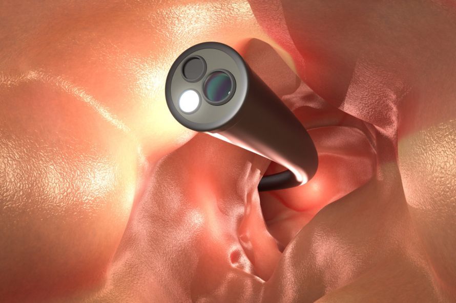 Darmspiegelung Colonoscopy